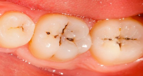 kavitete