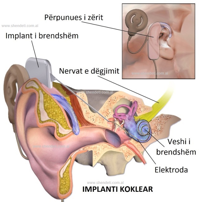 implanti koklear